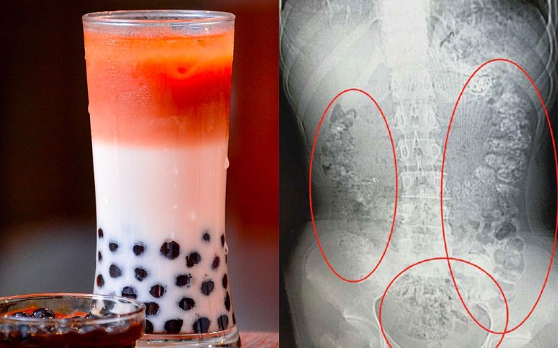Bubble Tea ထဲက ပုလဲလုံးလေးကြောင့် တရုတ်နိုင်ငံကမိန်းကလေး ဘယ်လိုဖြစ်သွားလဲ